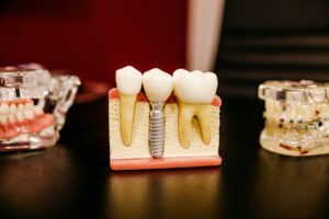 Patient receiving a dental implant follow-up while a clinician examines healing gums and jaw imaging.